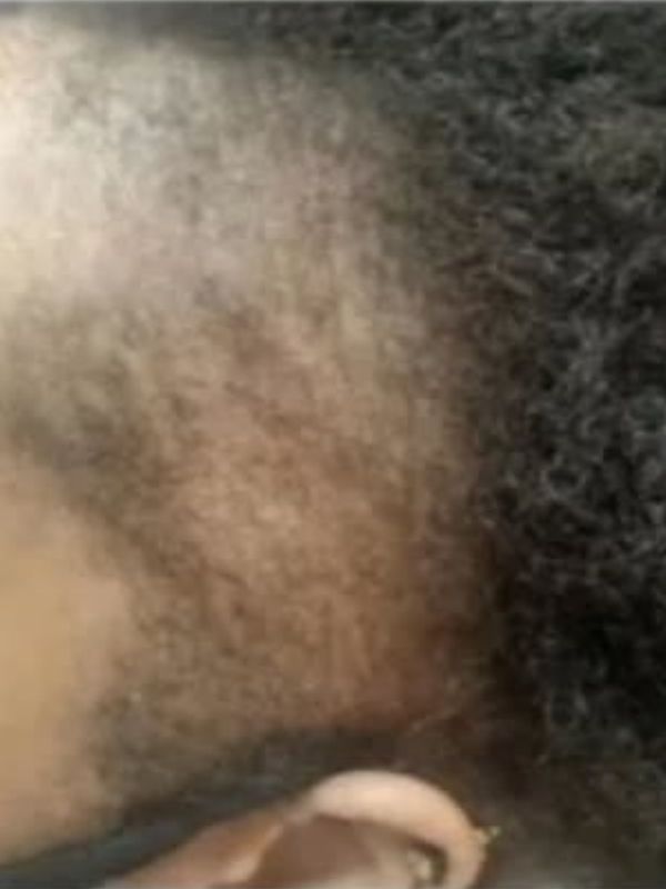 Before — Thinning hair treatment transformation